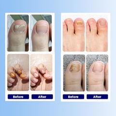 Aedydyce patch worn for eight hours on nail