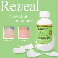 Applying ProLinc Callus Eliminator to callused areas for quick pedicure