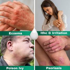 Hand applying Barmicil Plus to irritated skin.