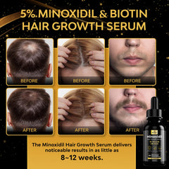 Beaueli Minoxidil foamy application, easy to apply on thinning areas.