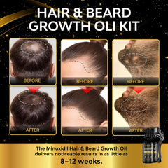 Beaueli minoxidil serum dropper demonstrates precise application for targeted thinning areas