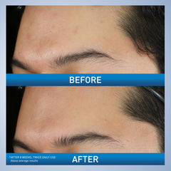 Label highlights 10% benzoyl peroxide for acne treatment