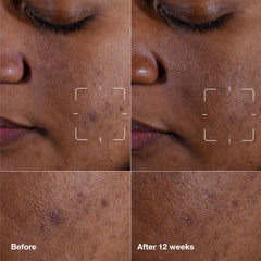 Clinique Even Better serum dropper on palm ready for precise application and fast absorption.