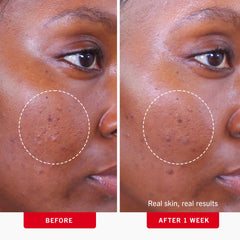 First Aid Beauty acne pads dual-sided pad in use.