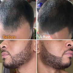 FOLLICLE BOOSTER Hairline Marker Pen filling gaps with natural results