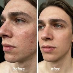 Generic Acne Balm with arnica and rosehip nourishes and soothes skin