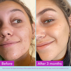 Cotton pad applying Good Molecules Niacinamide Brightening Toner to calm pores.