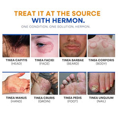 Hermon antifungal wash foam lather ready for cleansing