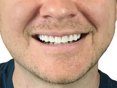 Instant Smile upper teeth placed over natural teeth for quick at home smile fix