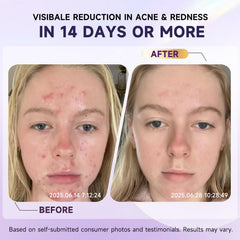 Targeted application on acne spots using Kempc cream.