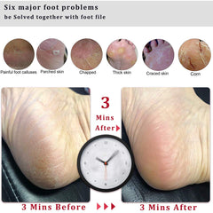 Double-sided Kinepi Foot File targets callus and rough skin for smoother feet.