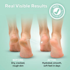 LV Lavinso Urea Cream 40% cracked heels closeup shows softening effect.