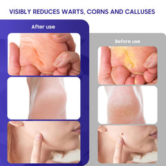 Luanerl Maximum Strength Formula delivers potent penetration for stubborn warts.
