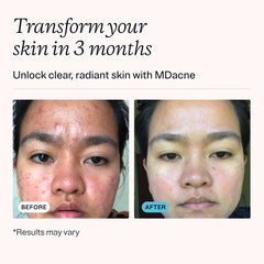 MDacne salicylic cleanser 0.5% in bottle helps clear pores