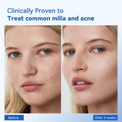 MEOLY Milia Remover Serum application dropper; precise dispensing for targeted treatment.
