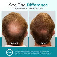 C'rcle Minoxidil 5% Foam provides even coverage on thinning areas.
