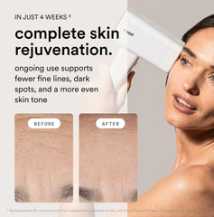 Nood Flasher Pro anti-aging lens swapped for smoother appearance.