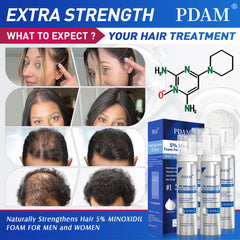 Pdam Minoxidil foam packaging box showing 4 month supply