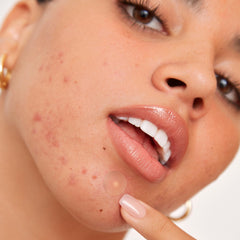 Peace Out Acne Healing Dots applied on pimples protect from picking during wear
