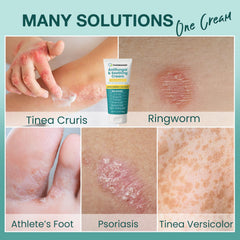 PHARMBANNER antifungal cream eases athlete's foot discomfort on contact.