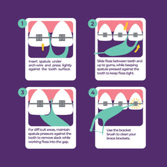 Platypus orthodontic flosser near brackets removes food particles safely.