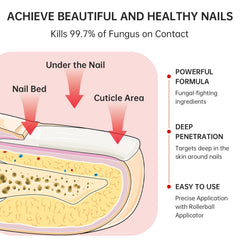 QQE Nail Fungus Treatment close-up shows nail discoloration for progress tracking.