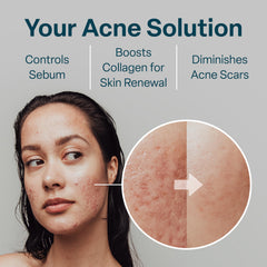 QRxLabs pads targeting bacne with exfoliation and balancing hydration.