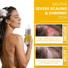 Rida Hair Psoriasis Shampoo bottle and pump for easy daily use.