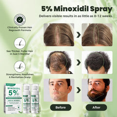SHIUMORE Minoxidil fine-mist dispersing evenly without greasiness