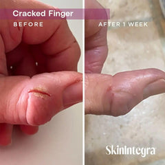 SkinIntegra Rapid Crack Repair Cream after surgery scar care, gentle healing support