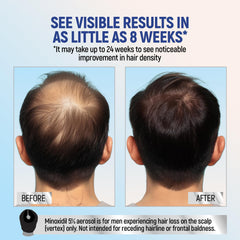 Close-up of TARO Minoxidil 5% foam being applied to the scalp.