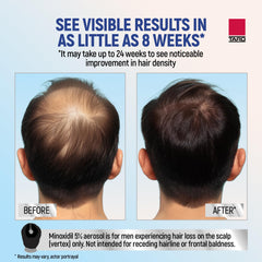 TARO Minoxidil foam dispense action demonstrated for easy daily use.