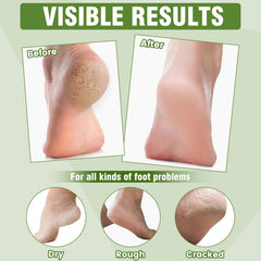 TEAWOO foot mask highlighting vitamin E and urea benefits for renewed skin.