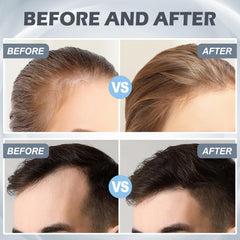 VANKEPYO derma roller for hair aids scalp care during routine sessions.