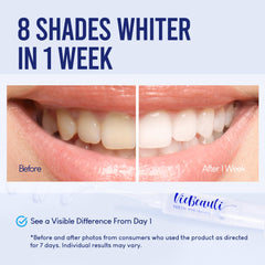 VieBeauti whitening gel pens for even application and gentle results