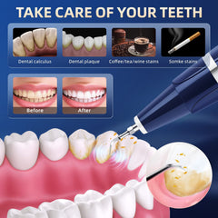 Vtiisamao dental calculus remover LED light for better visibility while cleaning
