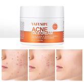 YAFUSIPE Acne Treatment bottle for gentle facial care and clearer skin.
