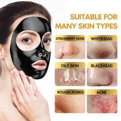 YLNALO four-piece blackhead tools arranged for precise extraction.