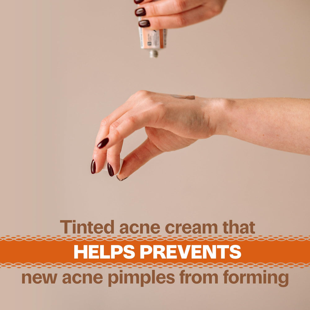 Adult Acnomel cream on hand shows lightweight texture.