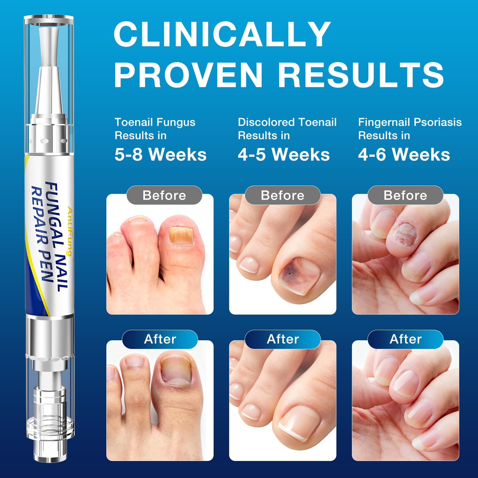 The AntiFung Toenail Pen travel-compact design fits in a bag for on-the-go care.