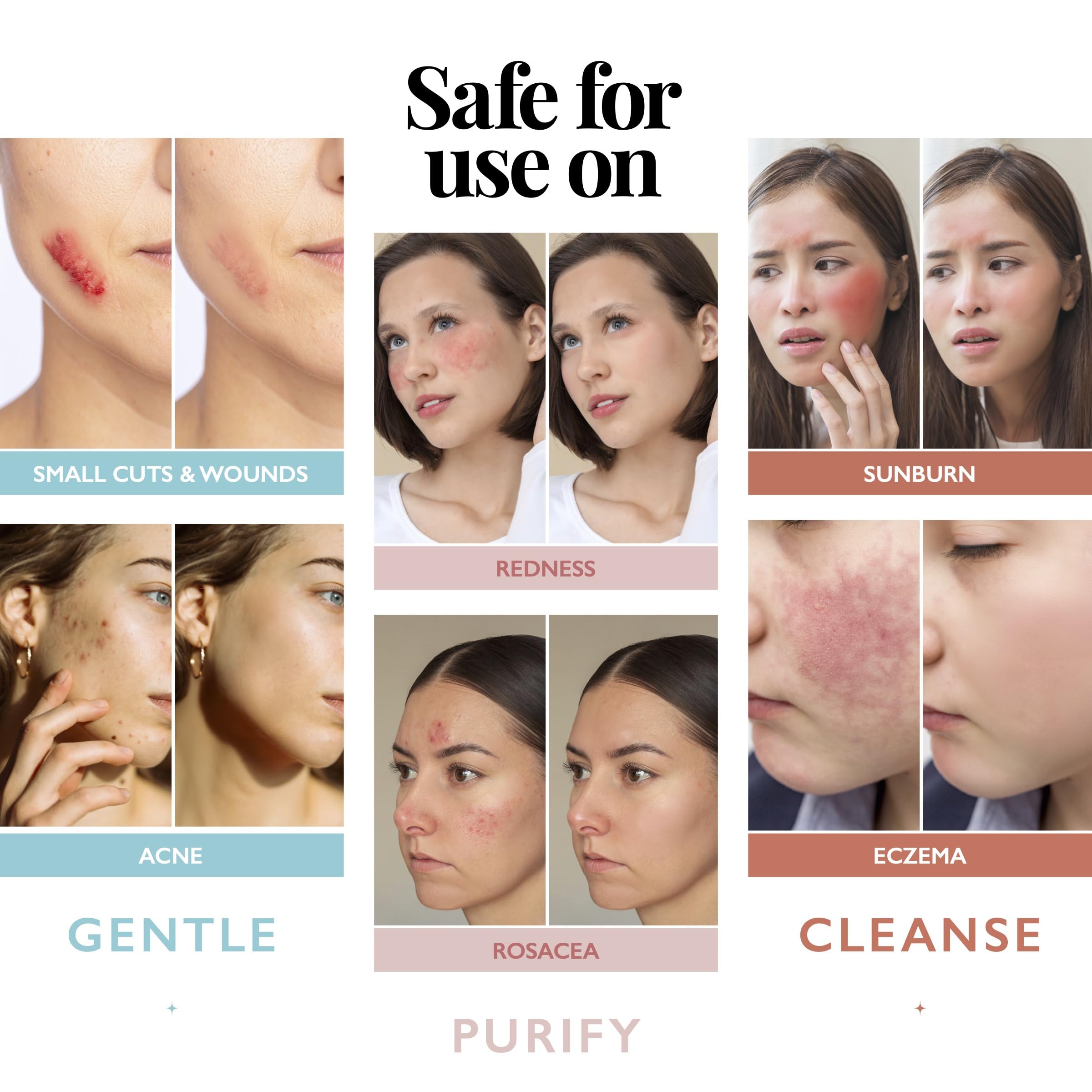 Aquia hypochlorous spray for skin-cleansing mist supports versatile acne-prone care.