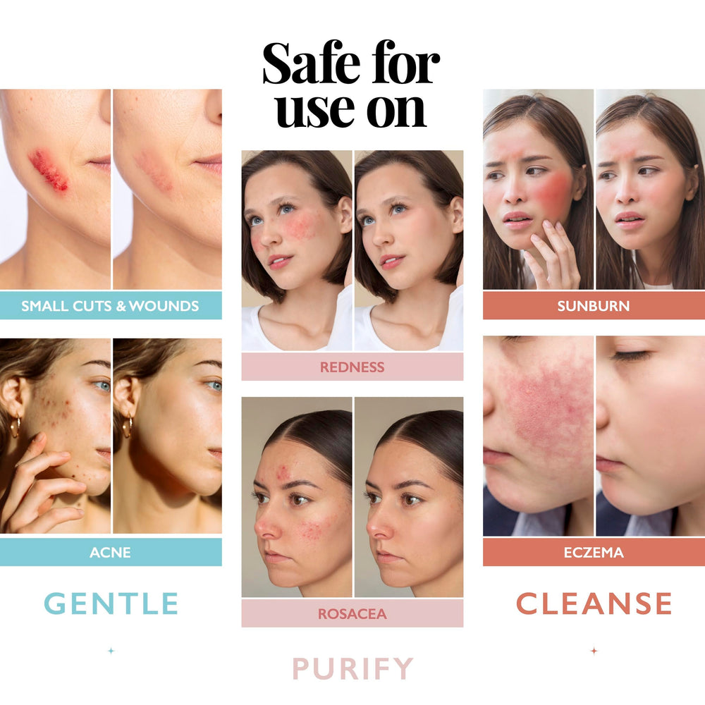 Aquia hypochlorous spray for skin-cleansing mist supports versatile acne-prone care.