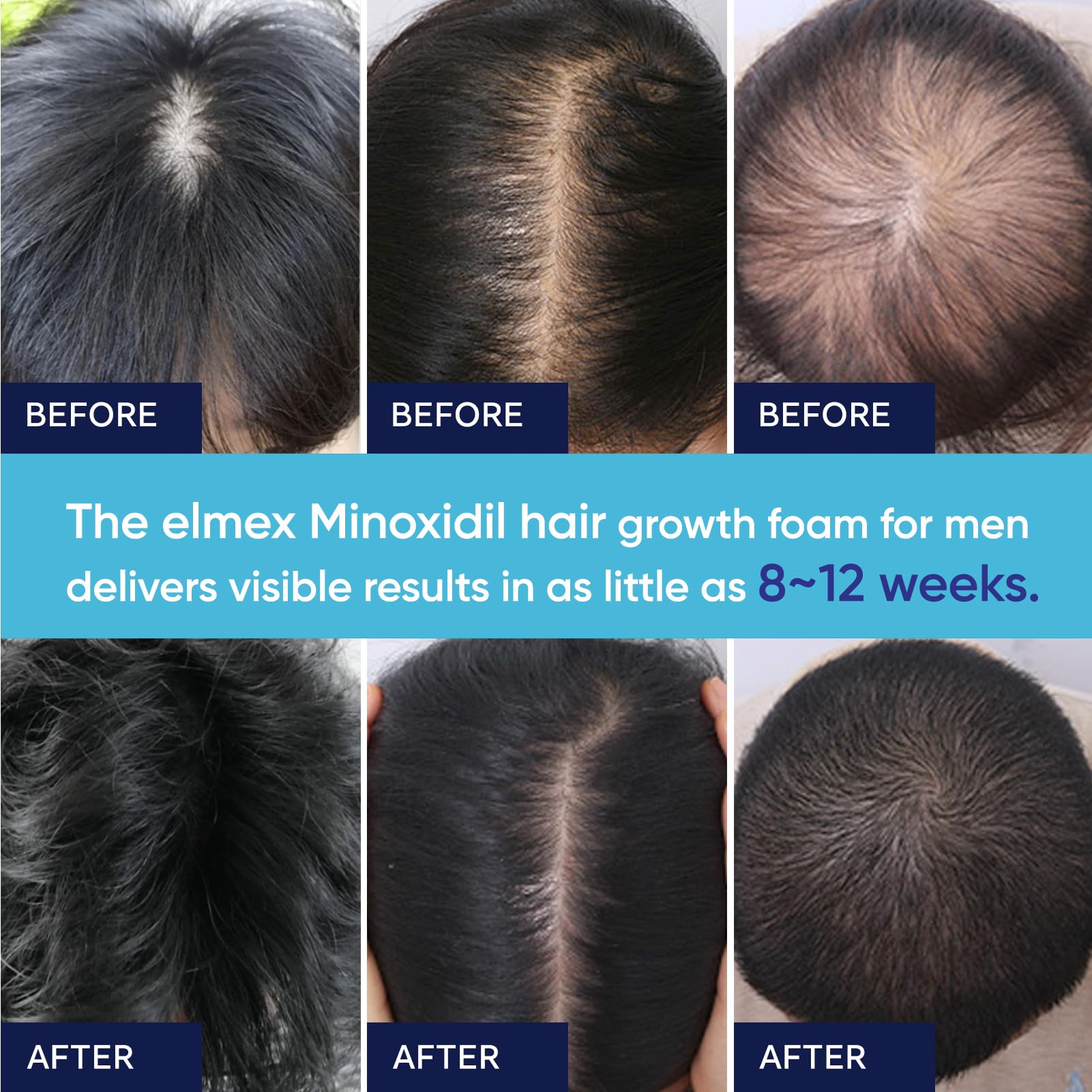 Artimore Minoxidil Foam dispenser demonstrating non-greasy finish