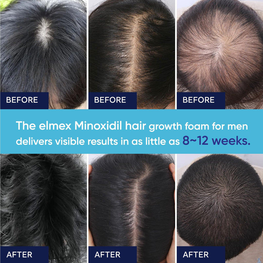 Artimore Minoxidil Foam dispenser demonstrating non-greasy finish