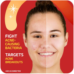 Asepxia dab-on application targeting a blemish on skin