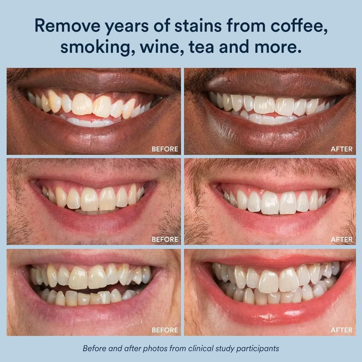 AuraGlow whitening system complements at-home routines with full kit compatibility