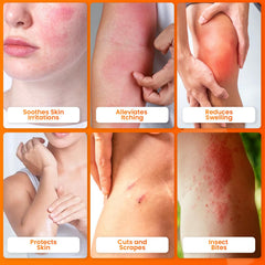 Applying AVEDANA ointment to affected skin for soothing relief