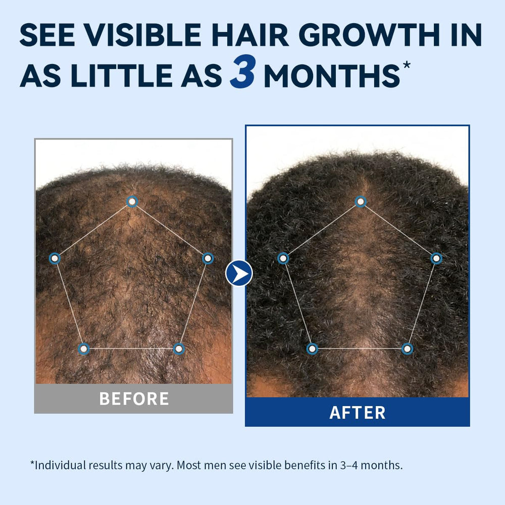 AVITAPURE active ingredients on label: biotin, rosemary, castor oil for scalp nourishment