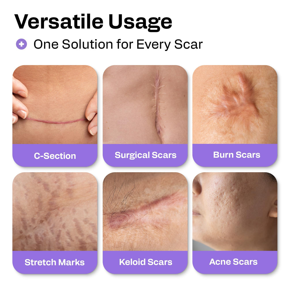 Face acne scar application with AWD Medical silicone scar sheets for gentle adhesion