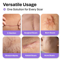 Face acne scar application with AWD Medical silicone scar sheets for gentle adhesion